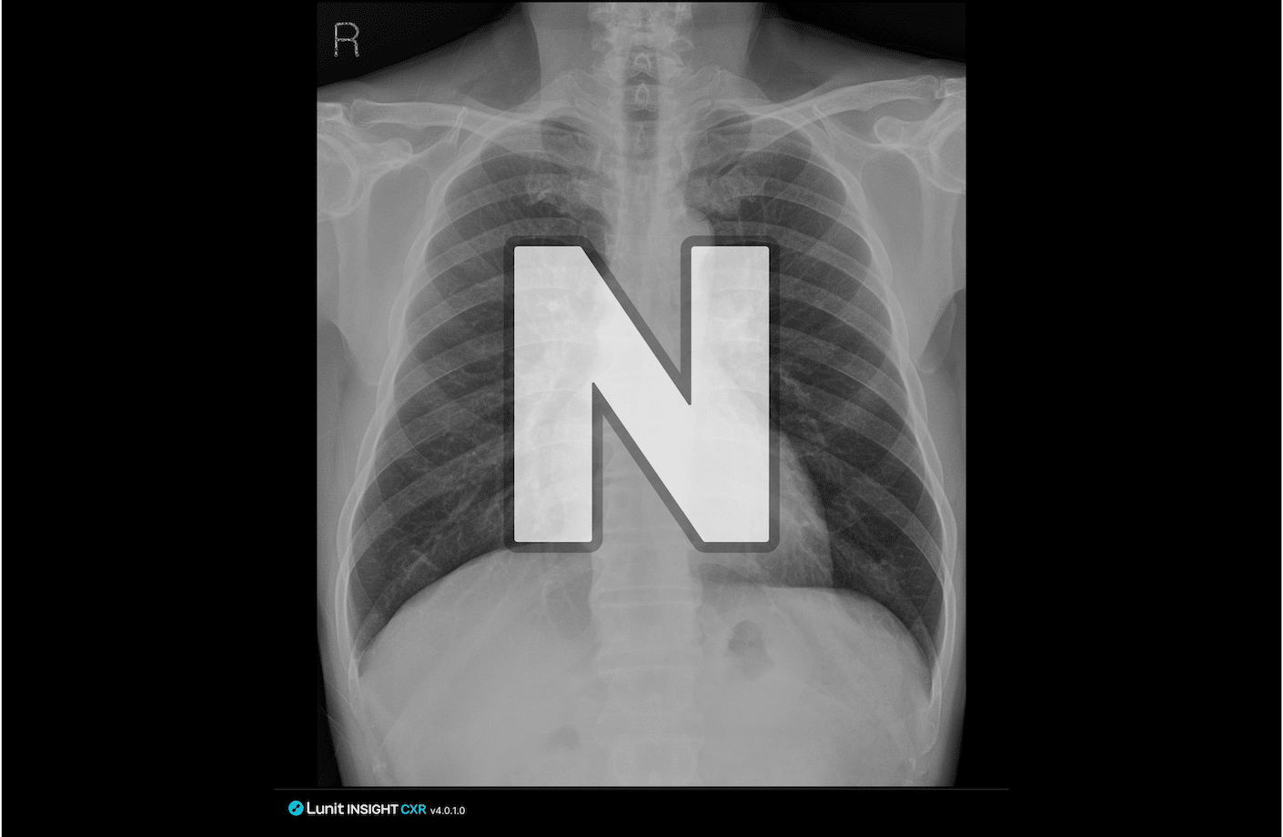 정상 케이스 판독보조