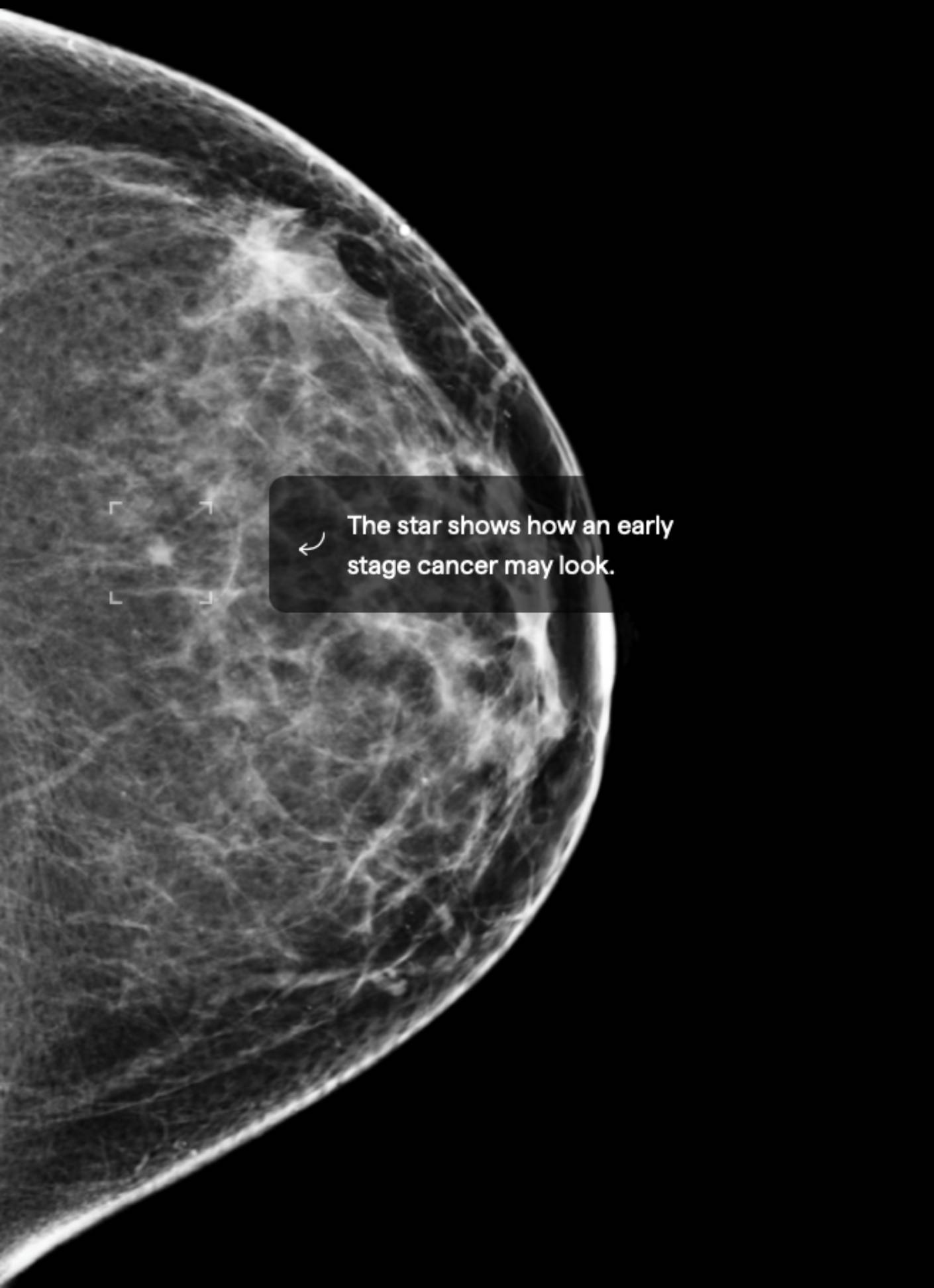B Low-mid tissue density SCATTERED AREAS OF DENSITY