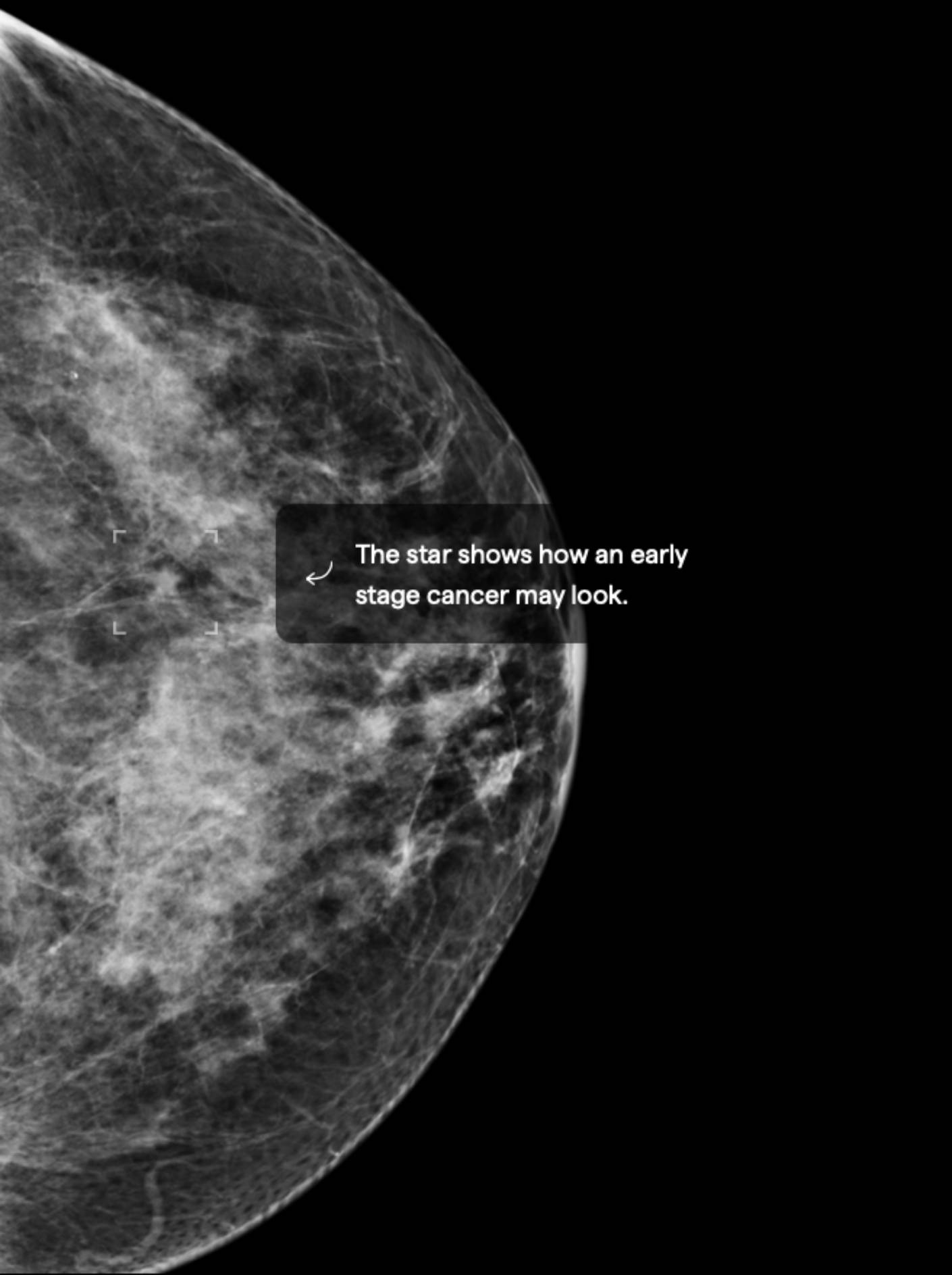 C Mid-high tissue density HETEROGENEOUSLY DENSE BREASTS