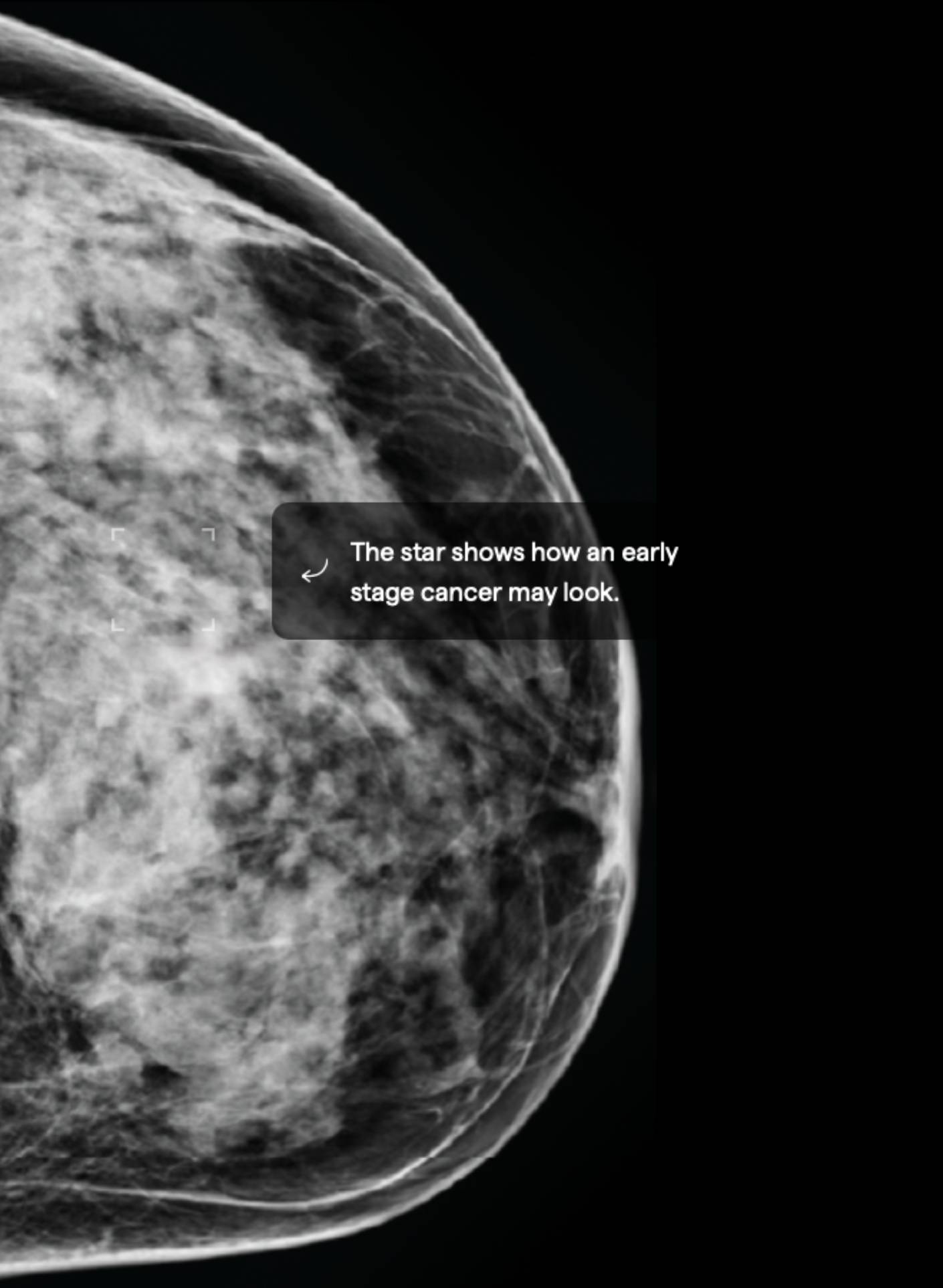 D High tissue density EXTREMELY DENSE BREASTS