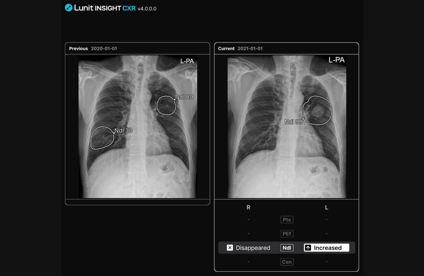 AI-assisted chest x-ray comparison showing detected lung nodule progression between current and prior scans.