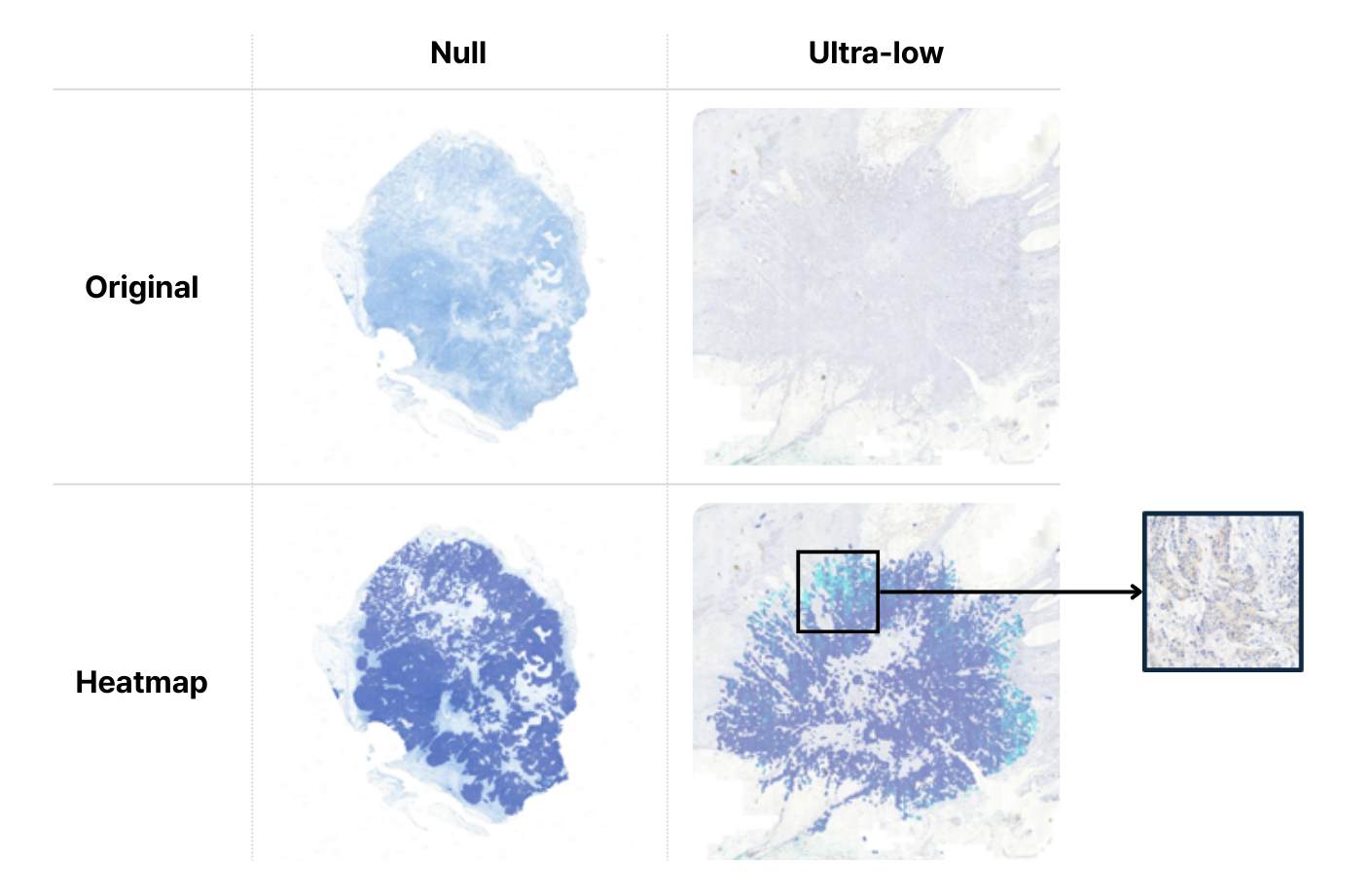 Comparison of original tissue slides and AI-generated heatmaps showing HER2 expression. Highlights AI detection of HER2 ultra-low signals that were previously scored as negative by pathologists.