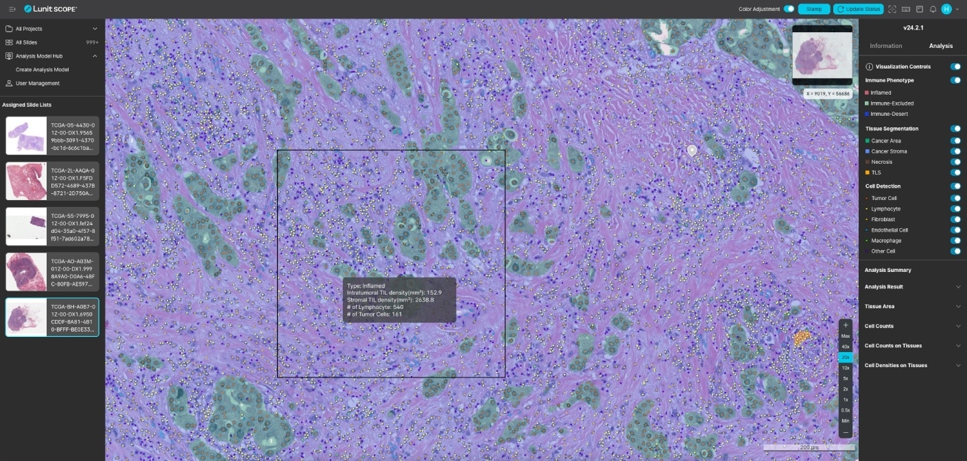 Digital pathology image showing AI-powered analysis of H&E tissue slides to identify tumor cells, fibroblasts, lymphocytes, and spatial patterns for biomarker discovery.