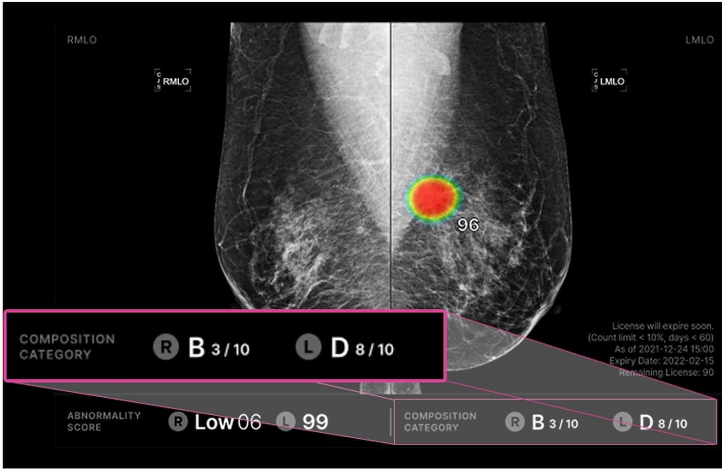양측 유방 치밀도 확인
